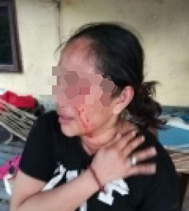 Diduga Cemburu, Wanita di Parepare Jadi Korban Penganiayaan Pacarnya